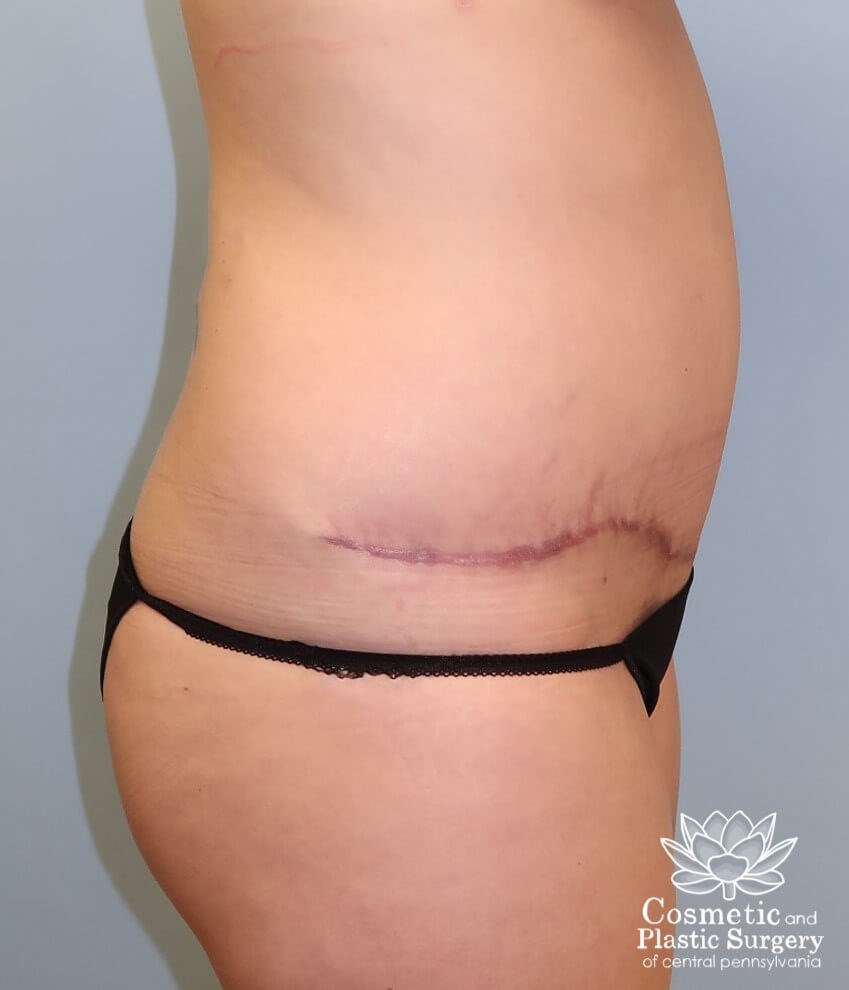 Abdominoplasty (Tummy Tuck) After