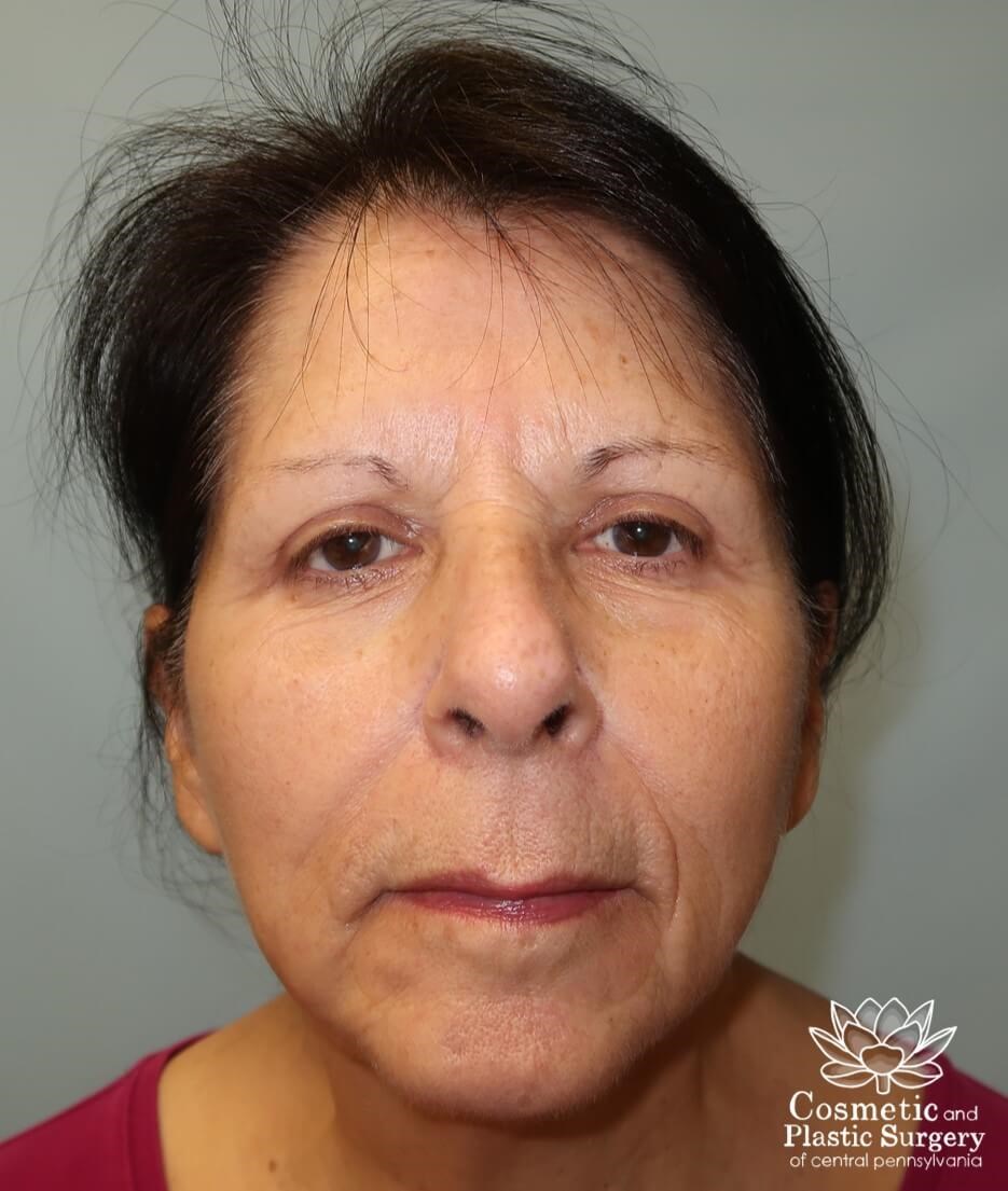 Facelift After