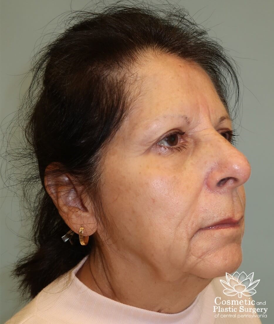 Facelift Before