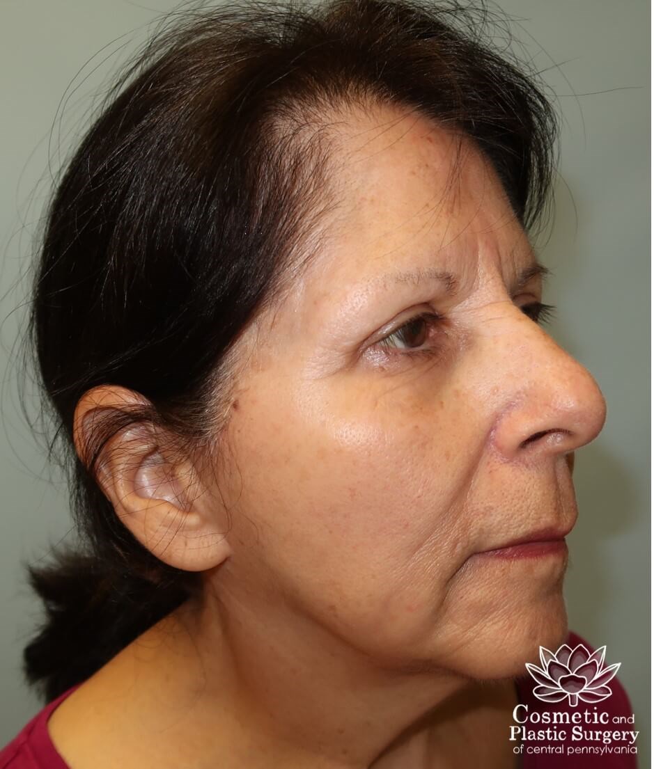 Facelift After