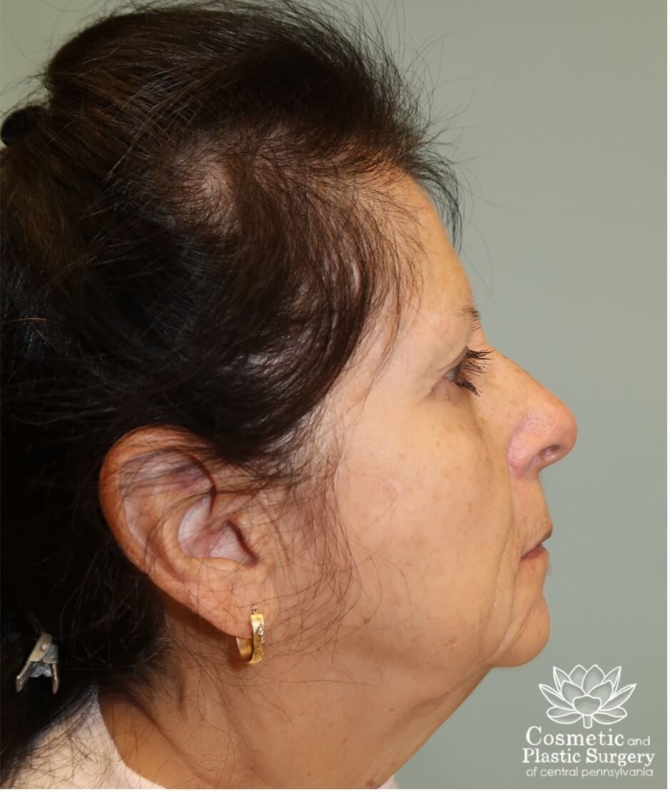 Facelift Before