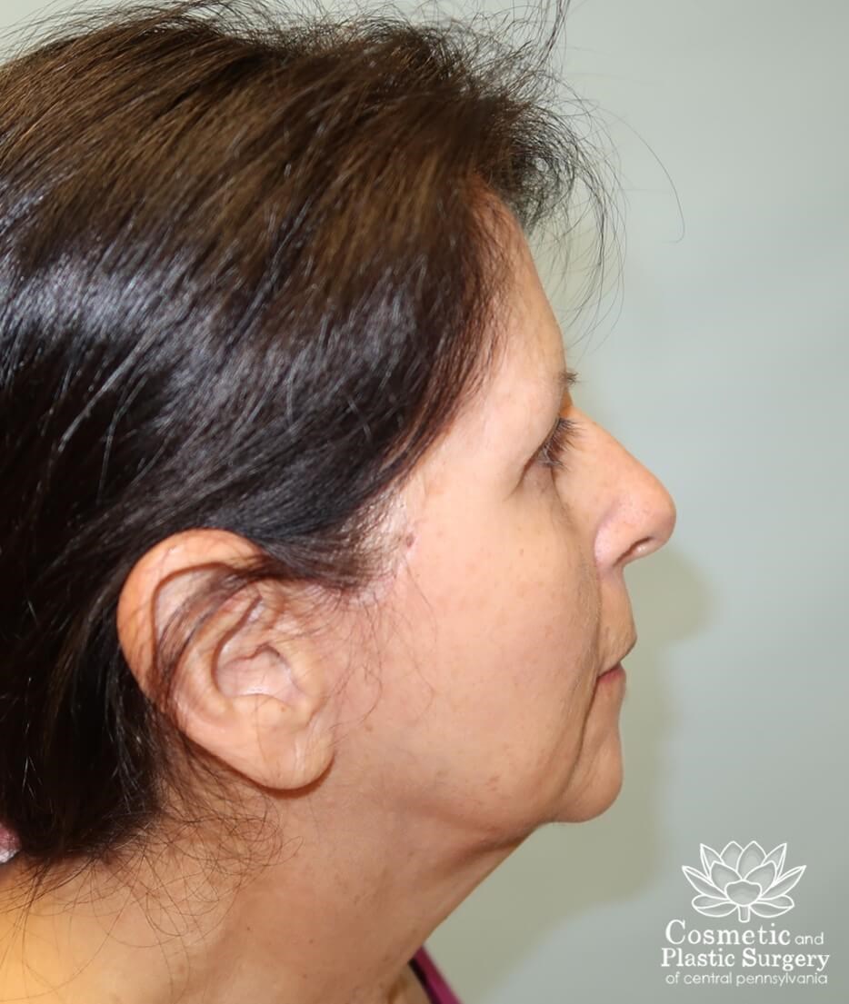 Facelift After