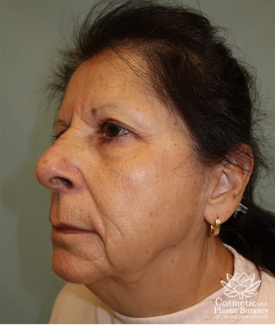 Facelift Before