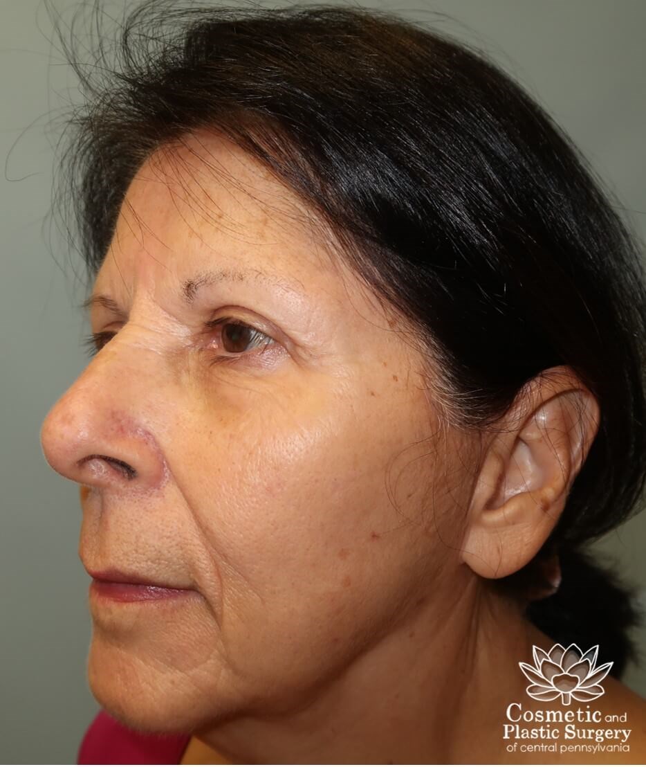 Facelift After