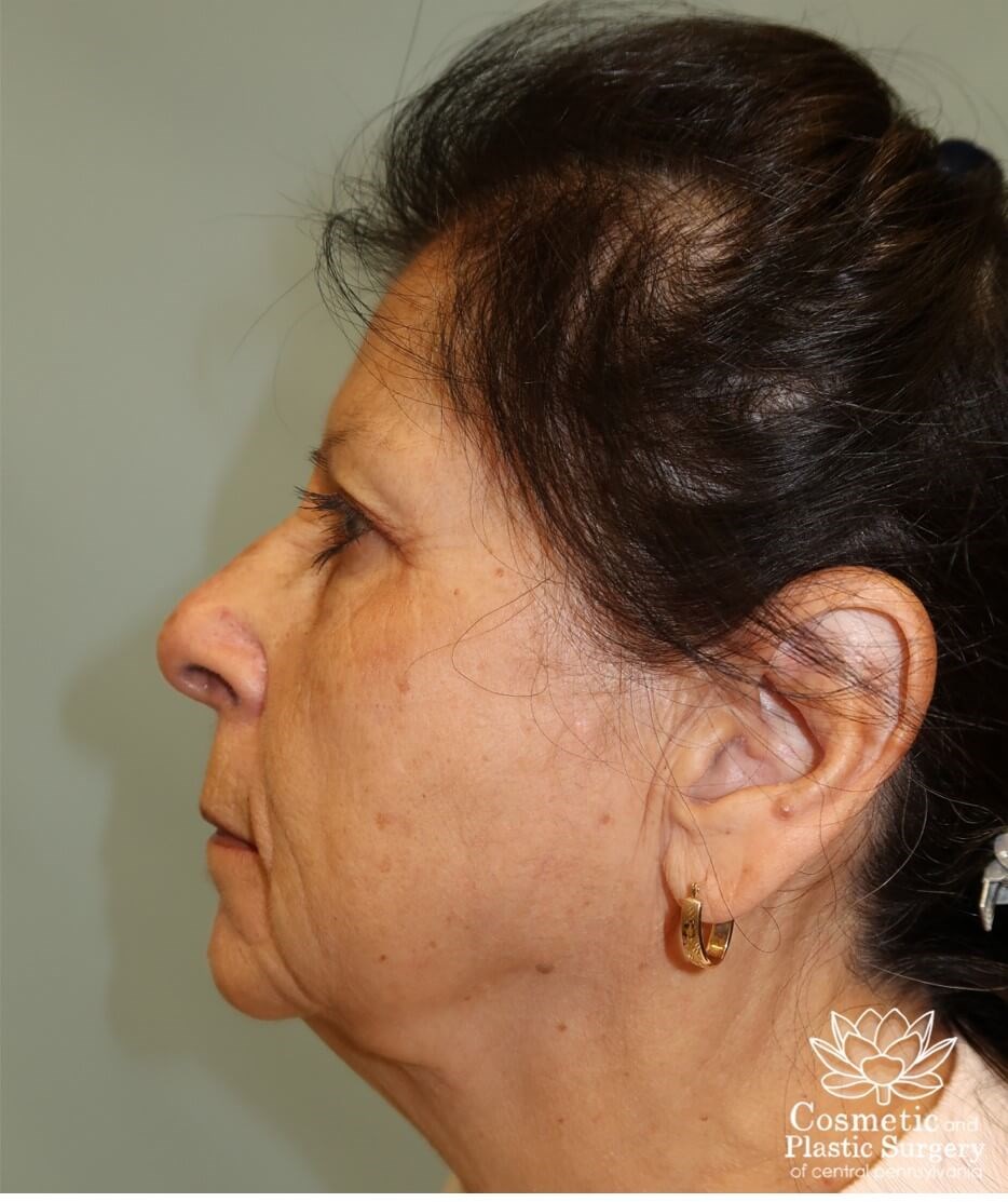 Facelift Before
