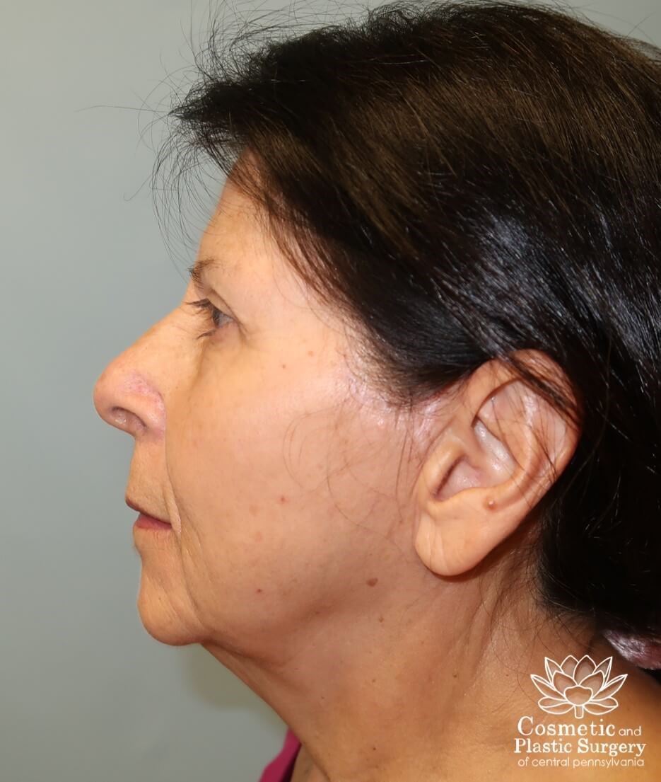 Facelift After