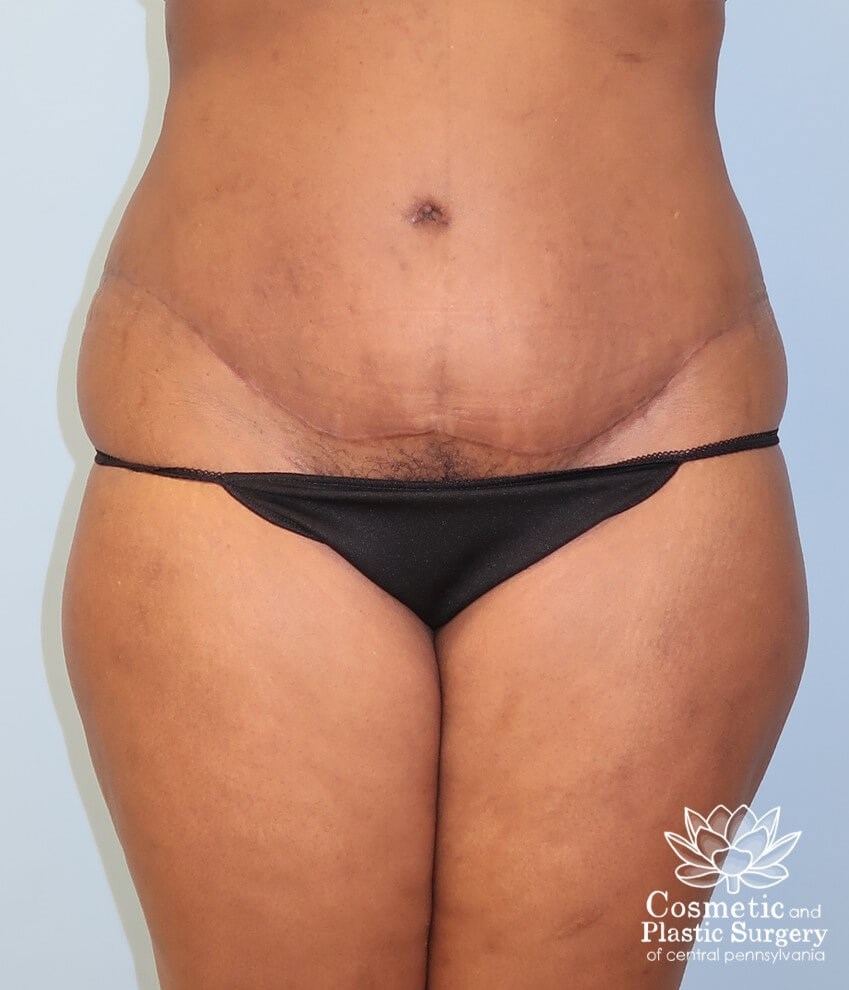 Abdominoplasty (Tummy Tuck) After