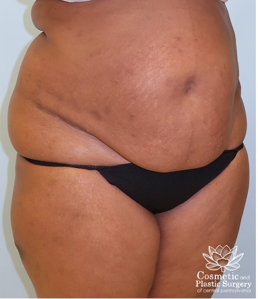 Abdominoplasty (Tummy Tuck) Before