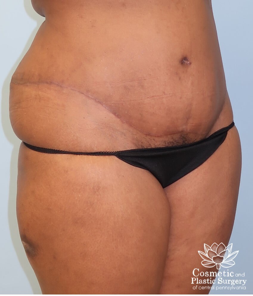 Abdominoplasty (Tummy Tuck) After