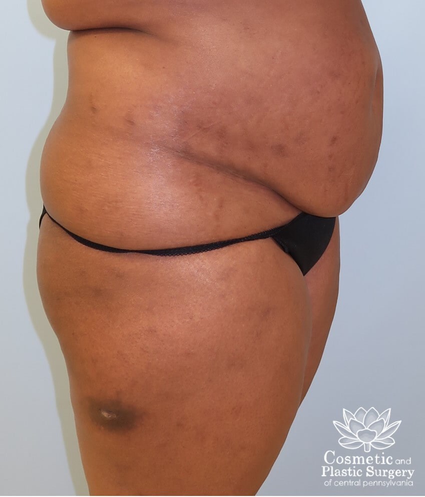 Abdominoplasty (Tummy Tuck) Before