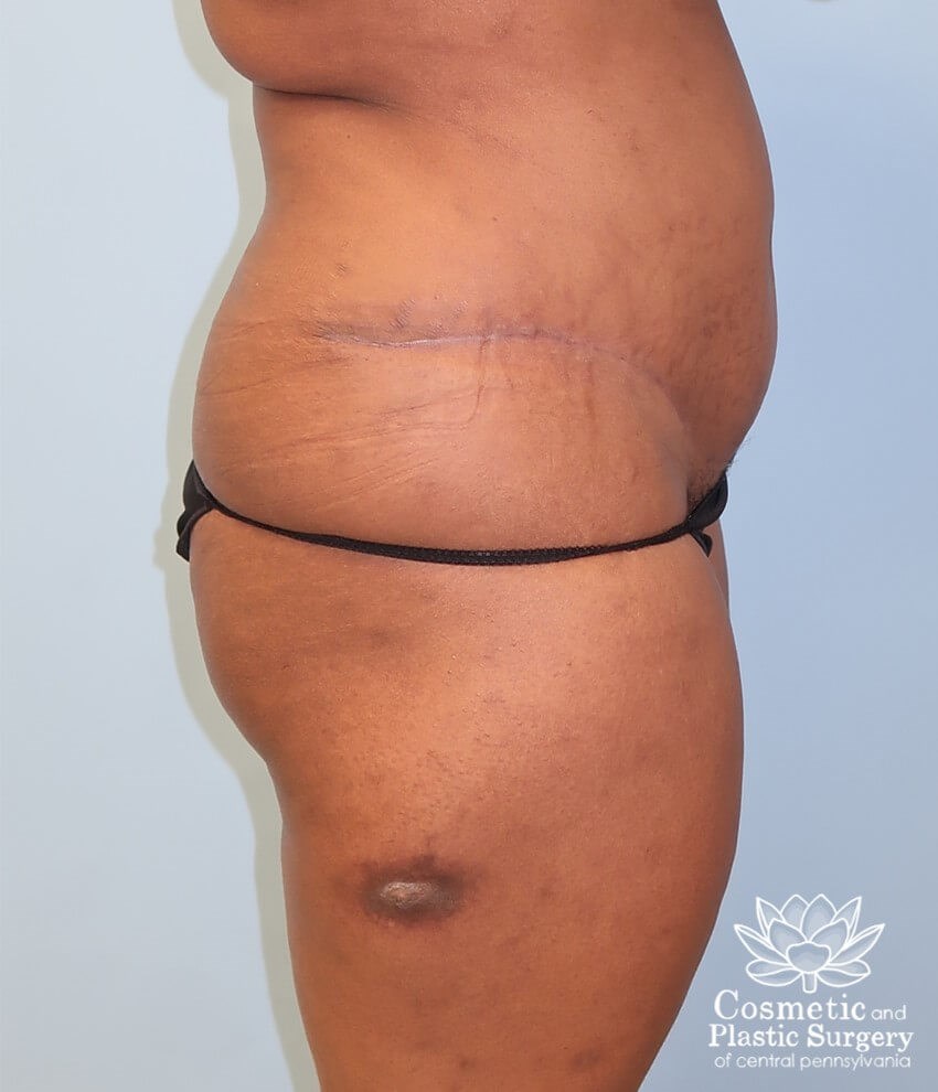 Abdominoplasty (Tummy Tuck) After