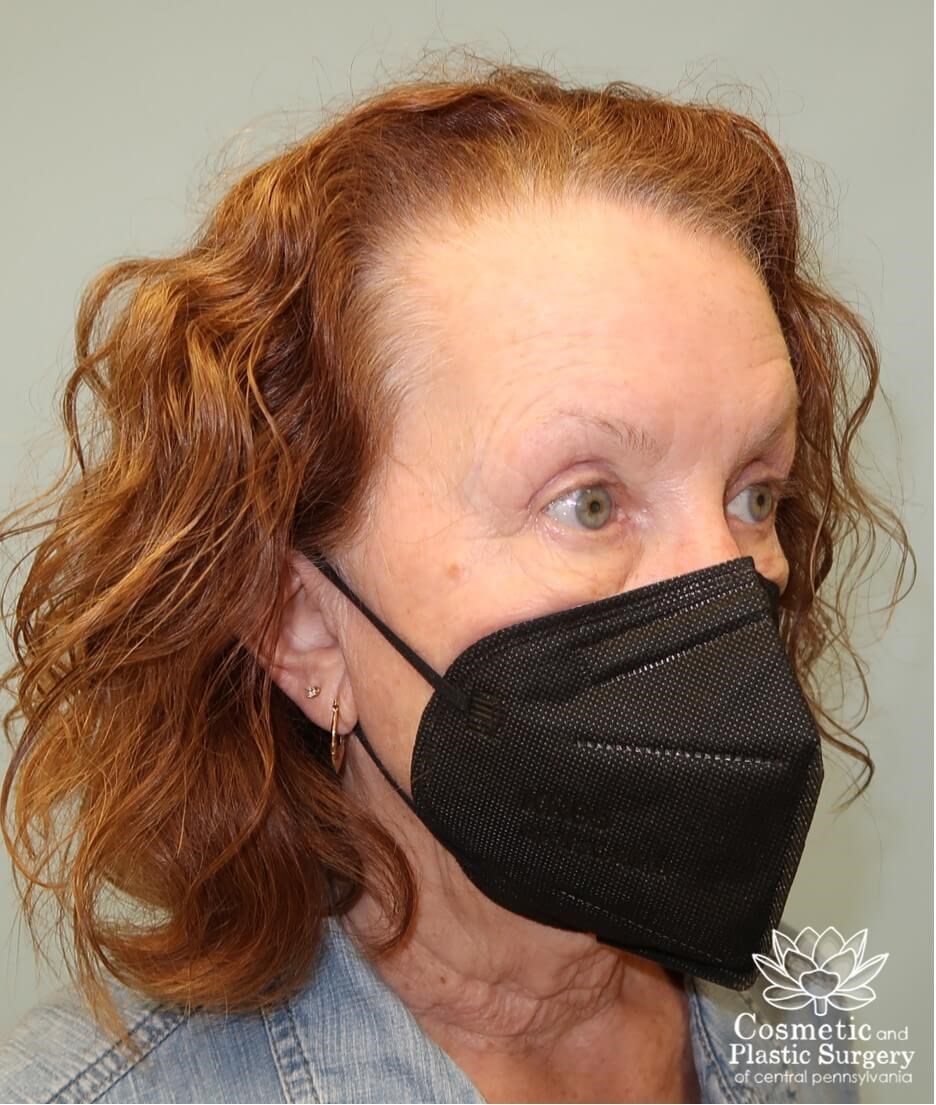 Blepharoplasty (upper eyelid) After