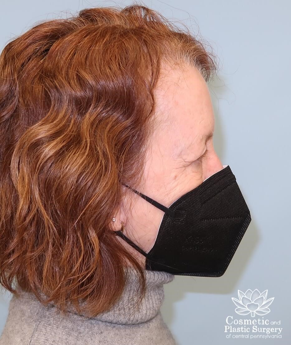 Blepharoplasty (upper eyelid) Before