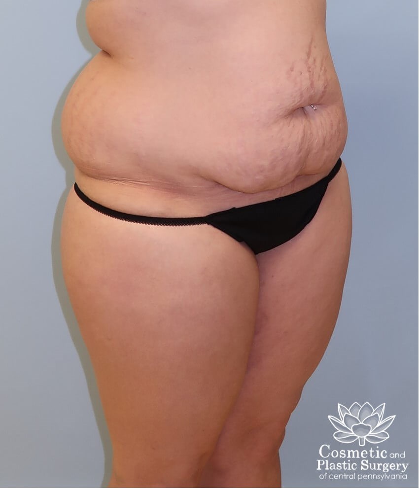 Circumferential body lift Before