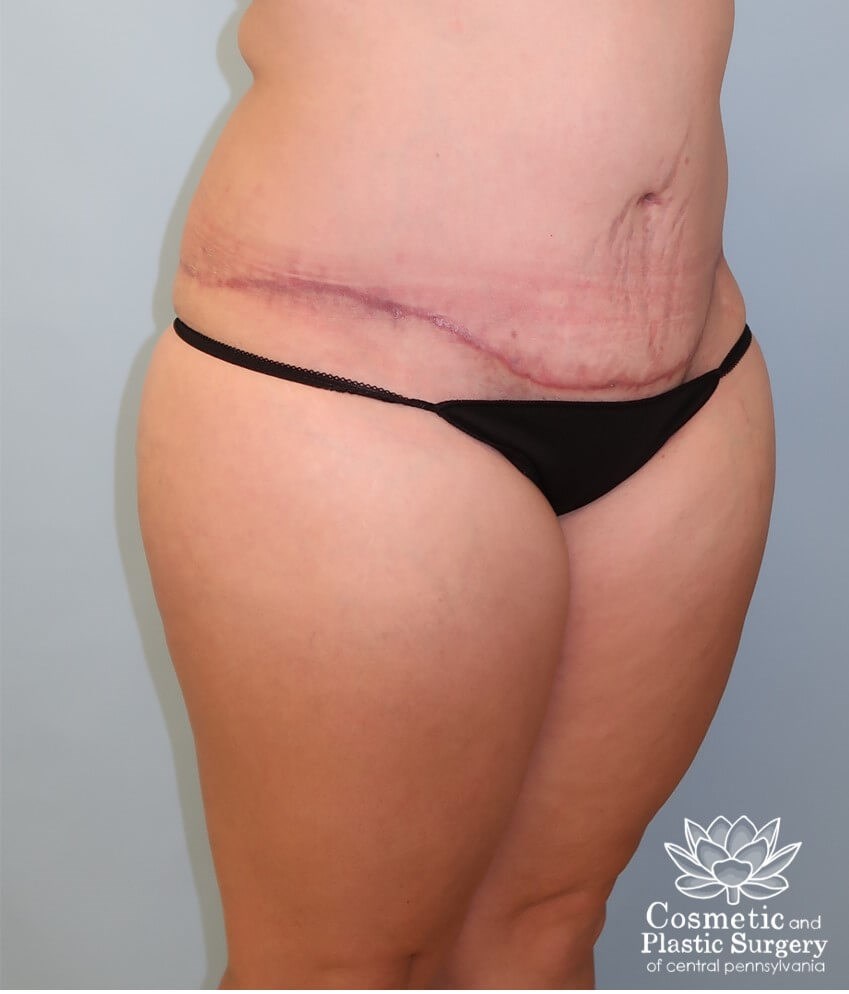 Circumferential body lift After