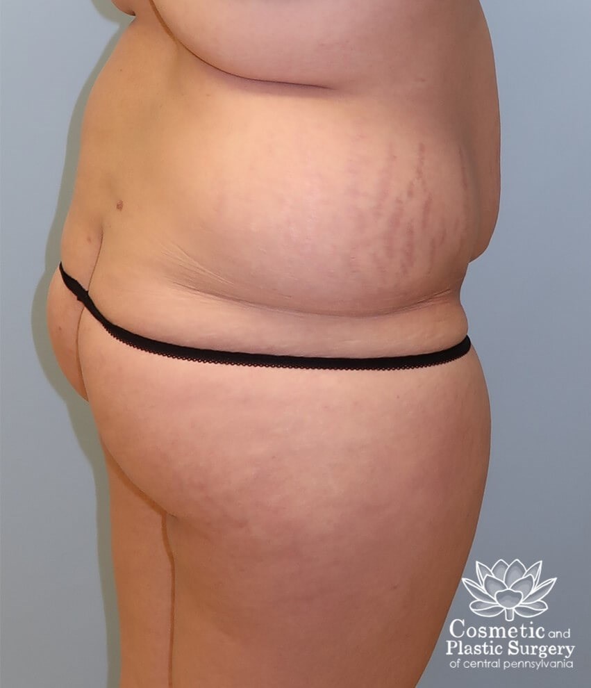 Circumferential body lift Before