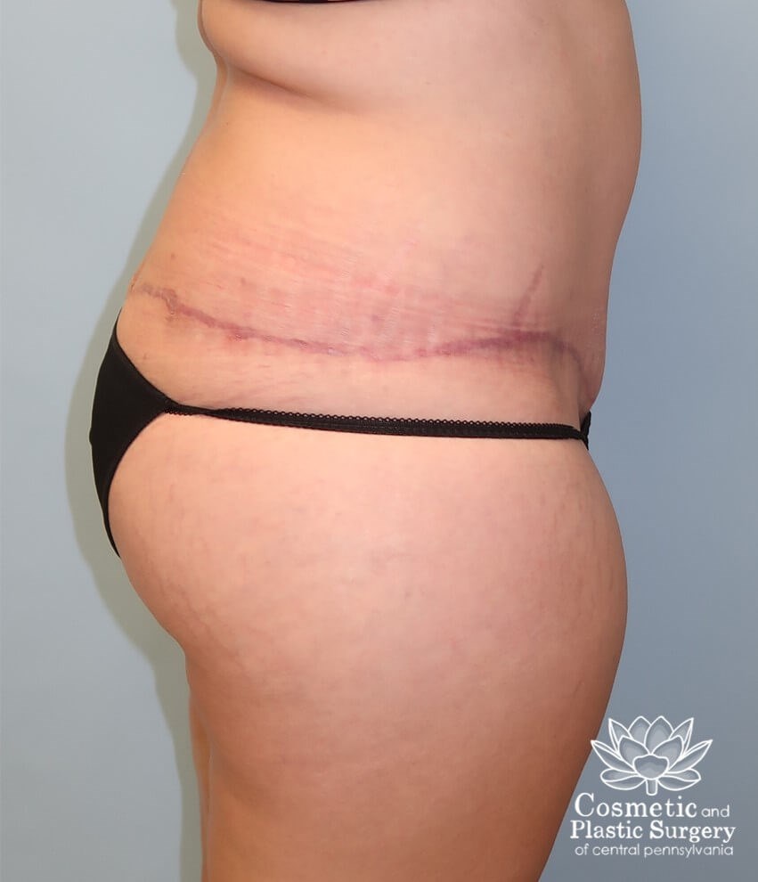 Circumferential body lift After