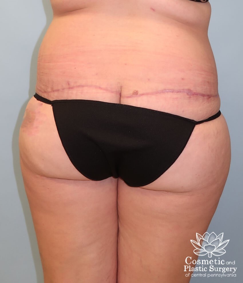 Circumferential body lift After