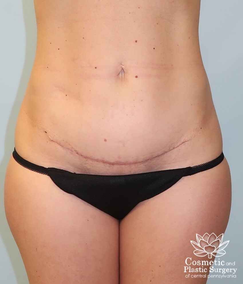 Mini Tummy Tuck After