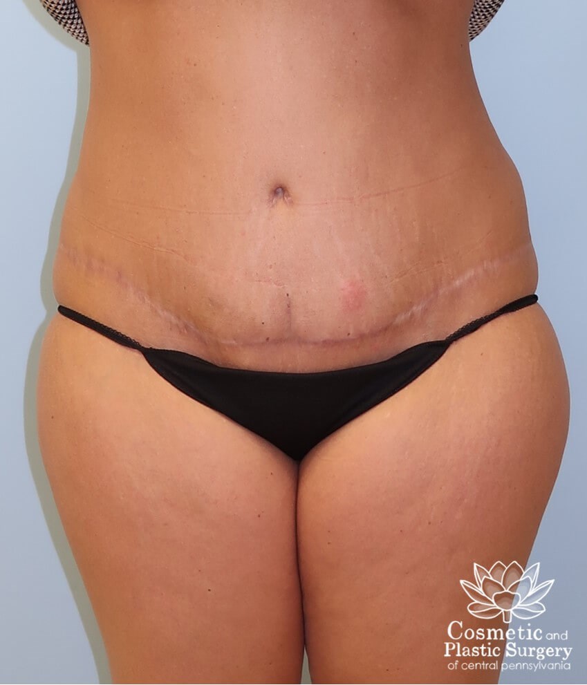 Abdominoplasty (Tummy Tuck) After