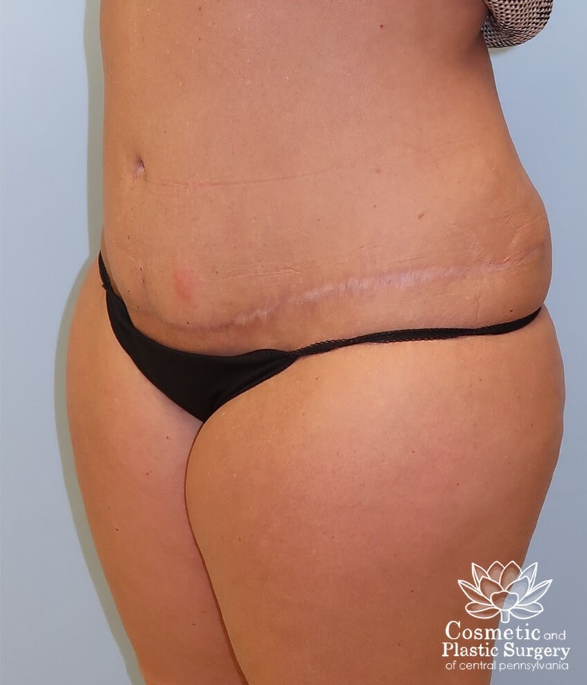 Abdominoplasty (Tummy Tuck) After