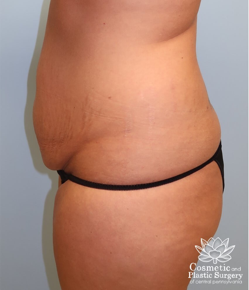 Abdominoplasty (Tummy Tuck) Before