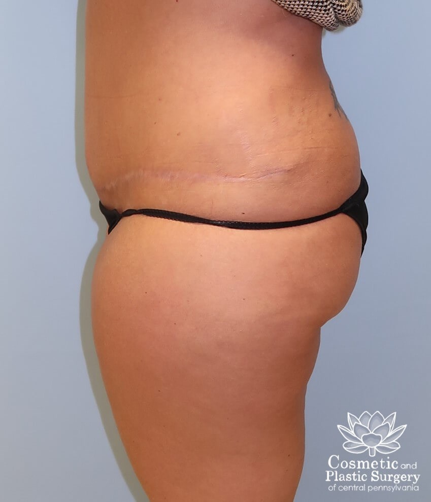 Abdominoplasty (Tummy Tuck) After
