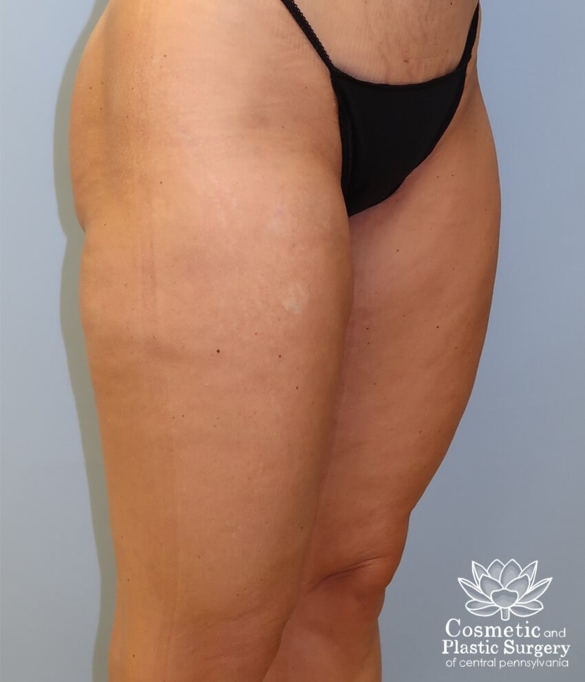 Leg Liposuction After