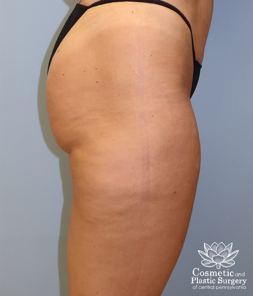 Leg Liposuction After