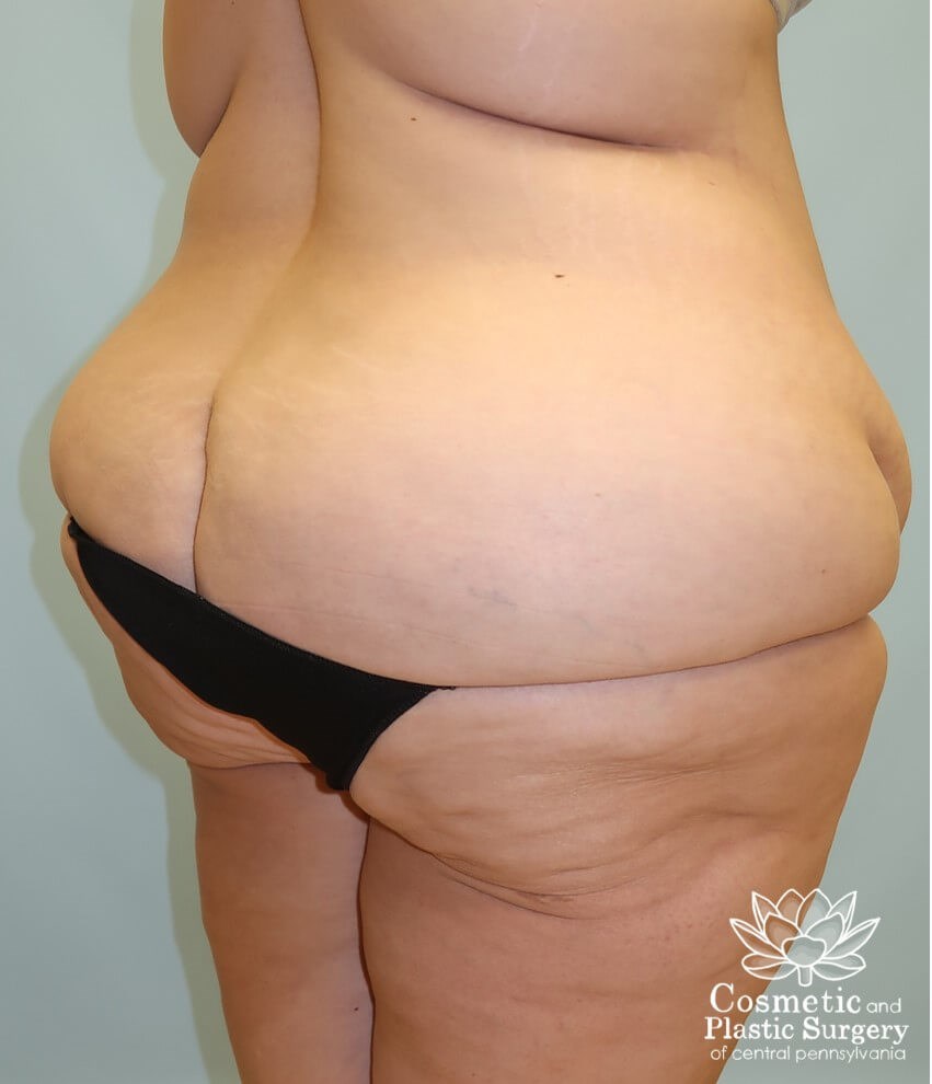 Lower Body Lift Before