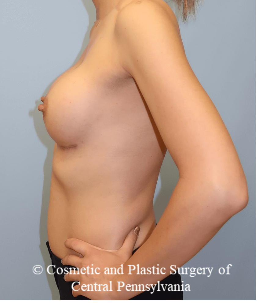 Breast Augmentation After