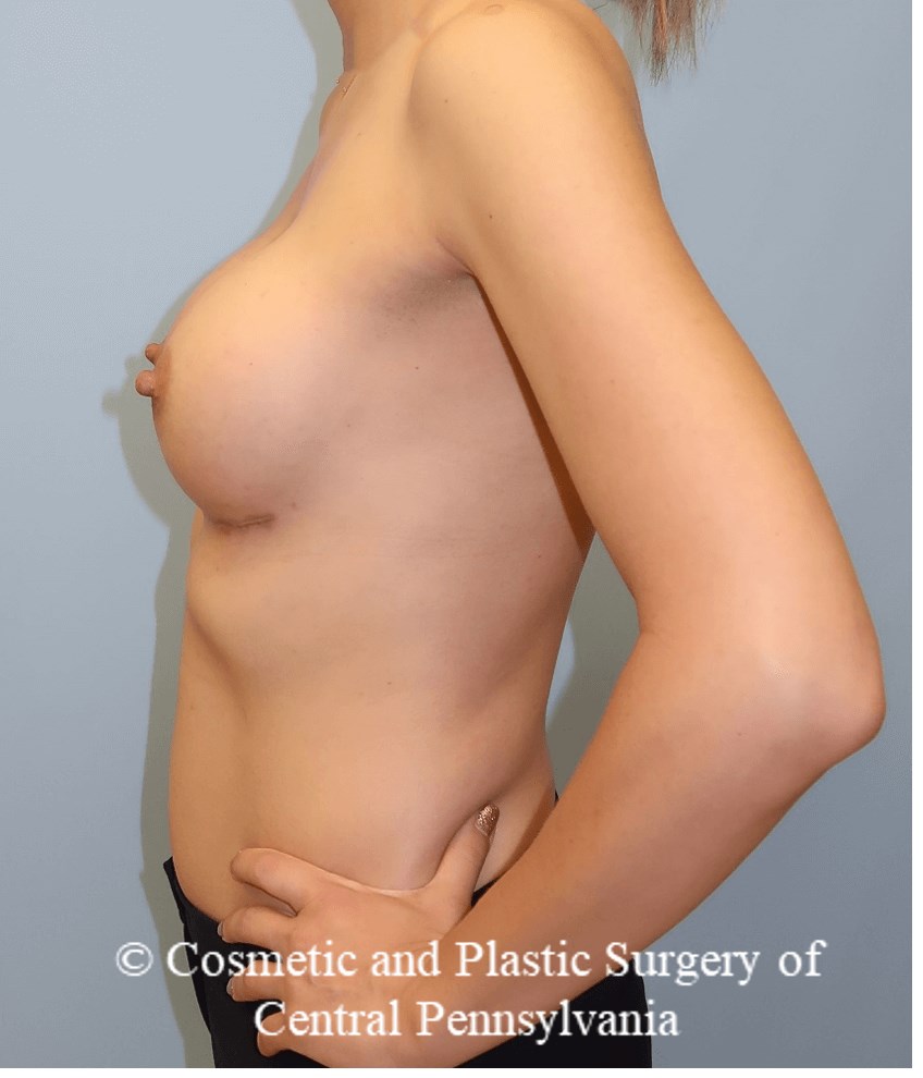 Breast Augmentation After