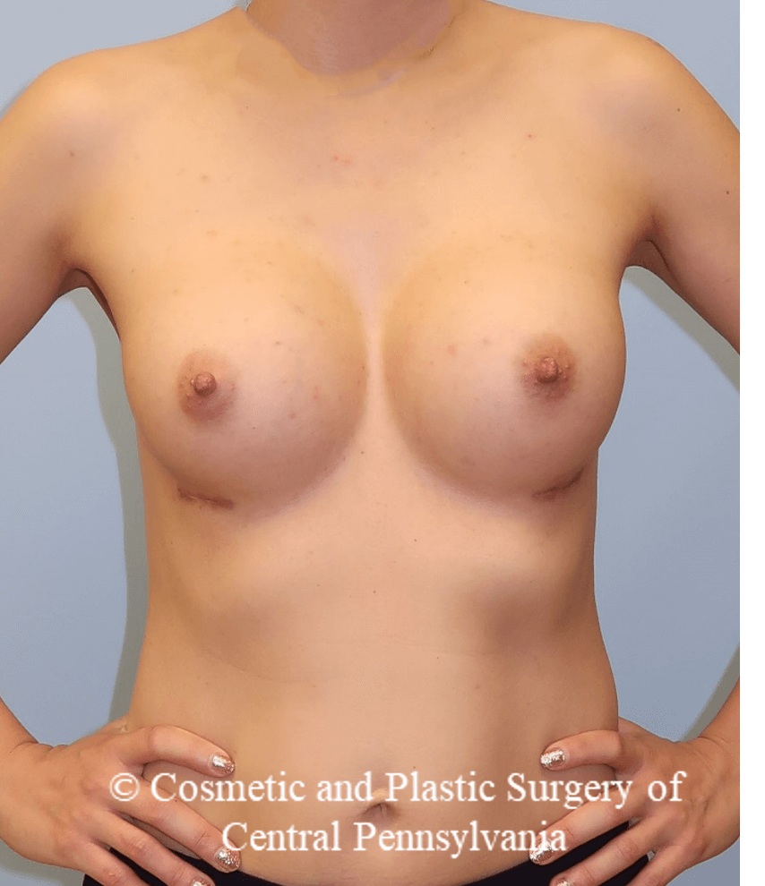 Breast Augmentation After