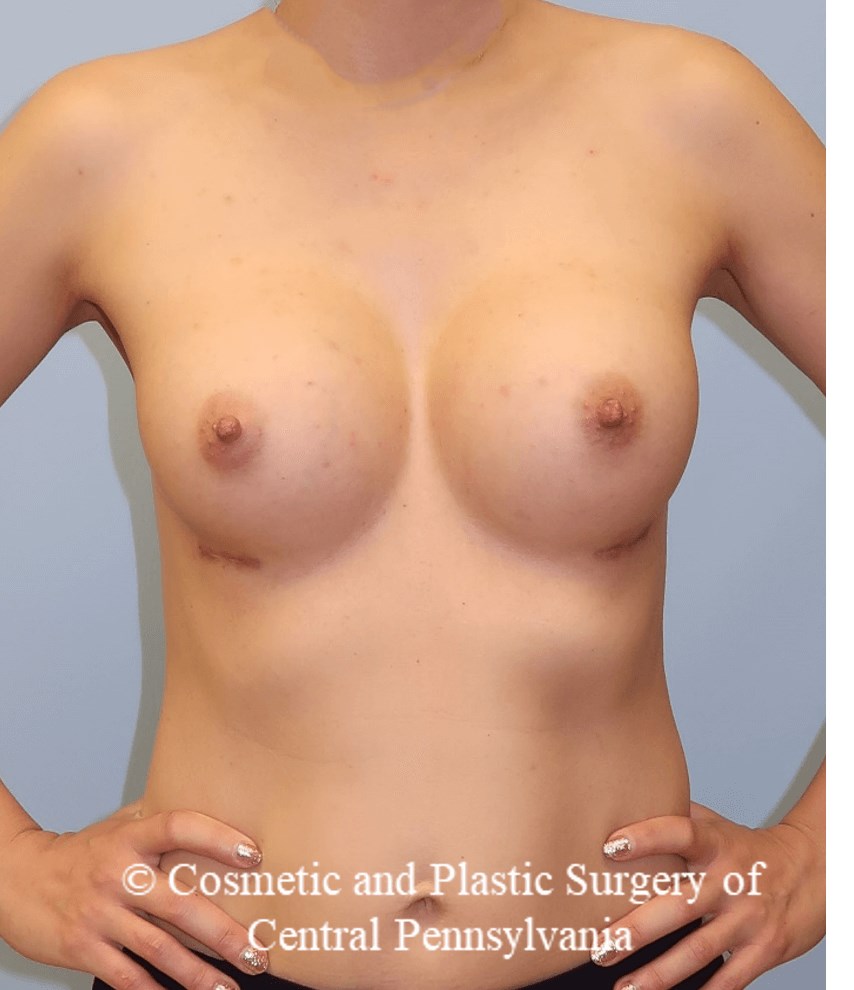 Breast Augmentation After