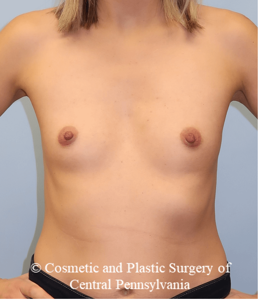 Breast Augmentation Before
