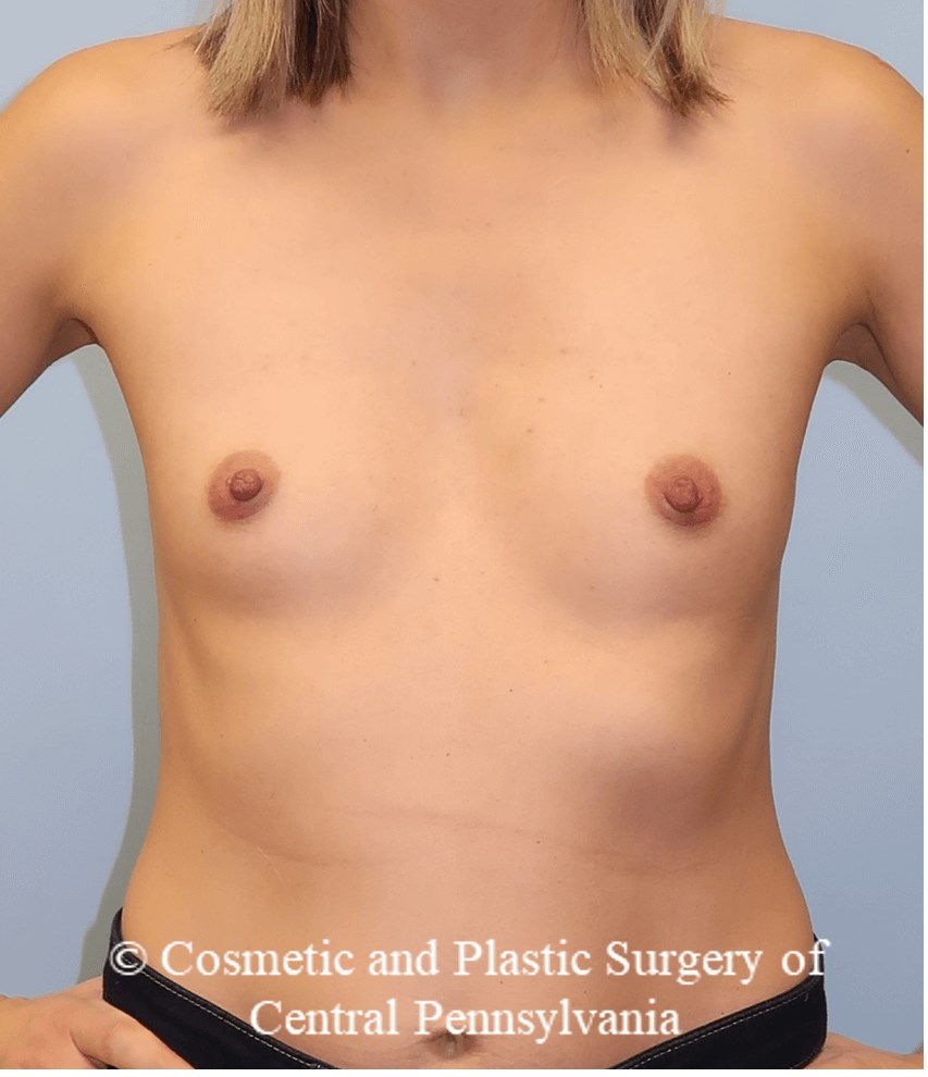 Breast Augmentation Before