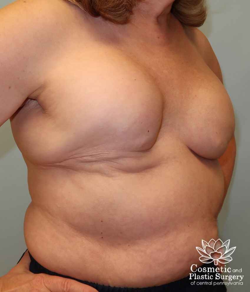 Breast Reconstruction revision Before