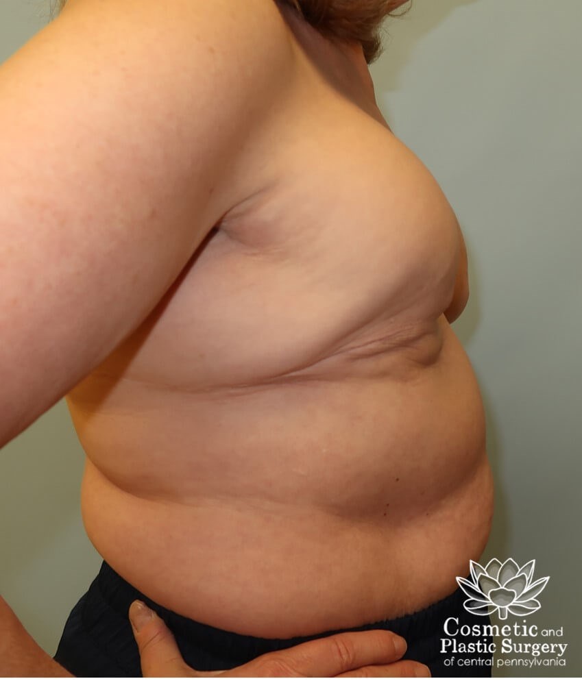 Breast Reconstruction revision Before