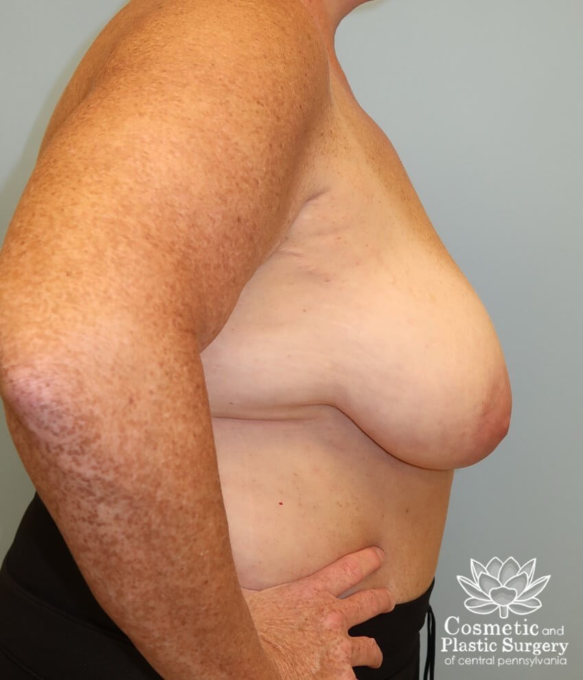 Breast Lift - Mastopexies Before