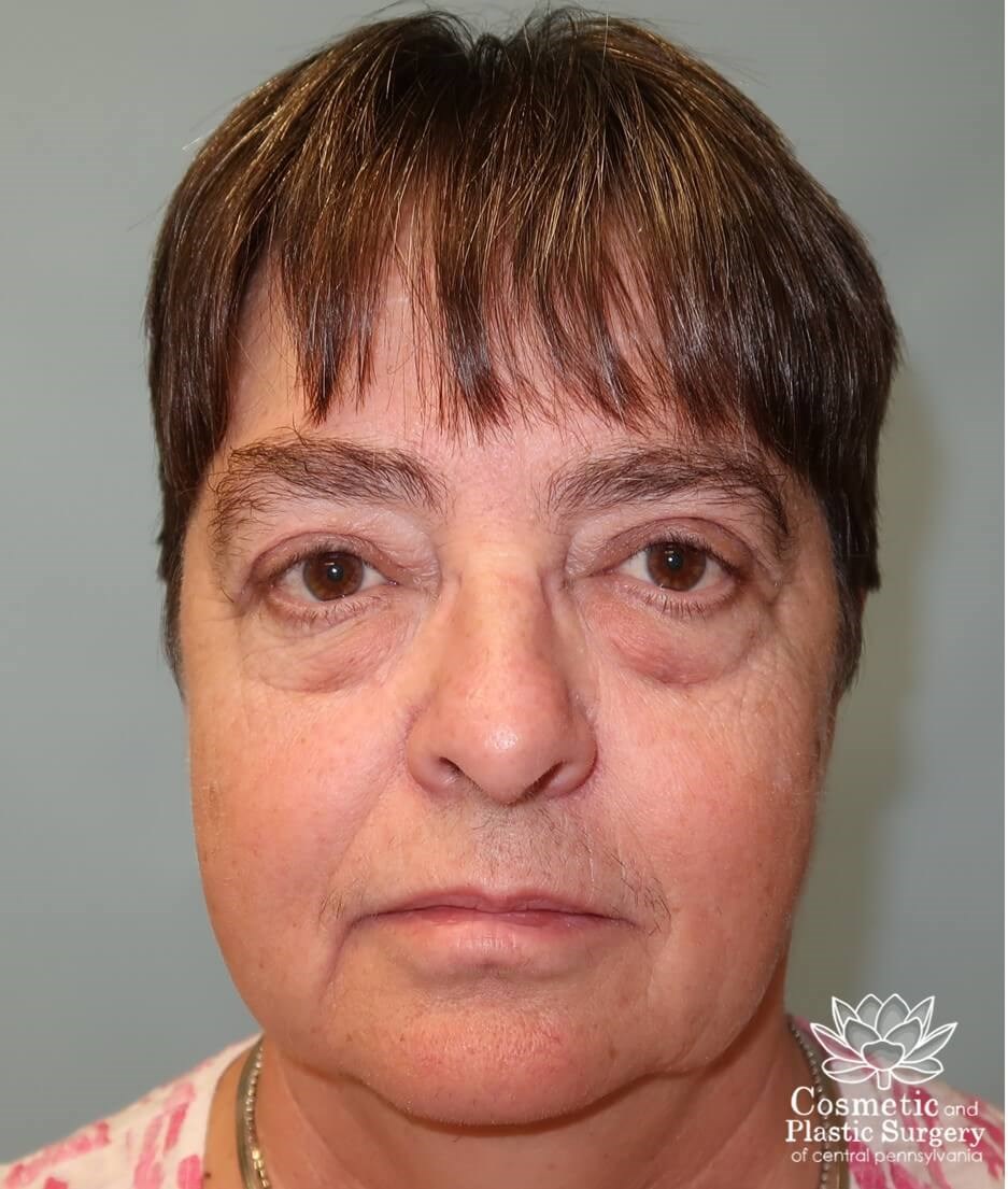 Blepharoplasty (upper eyelid) After
