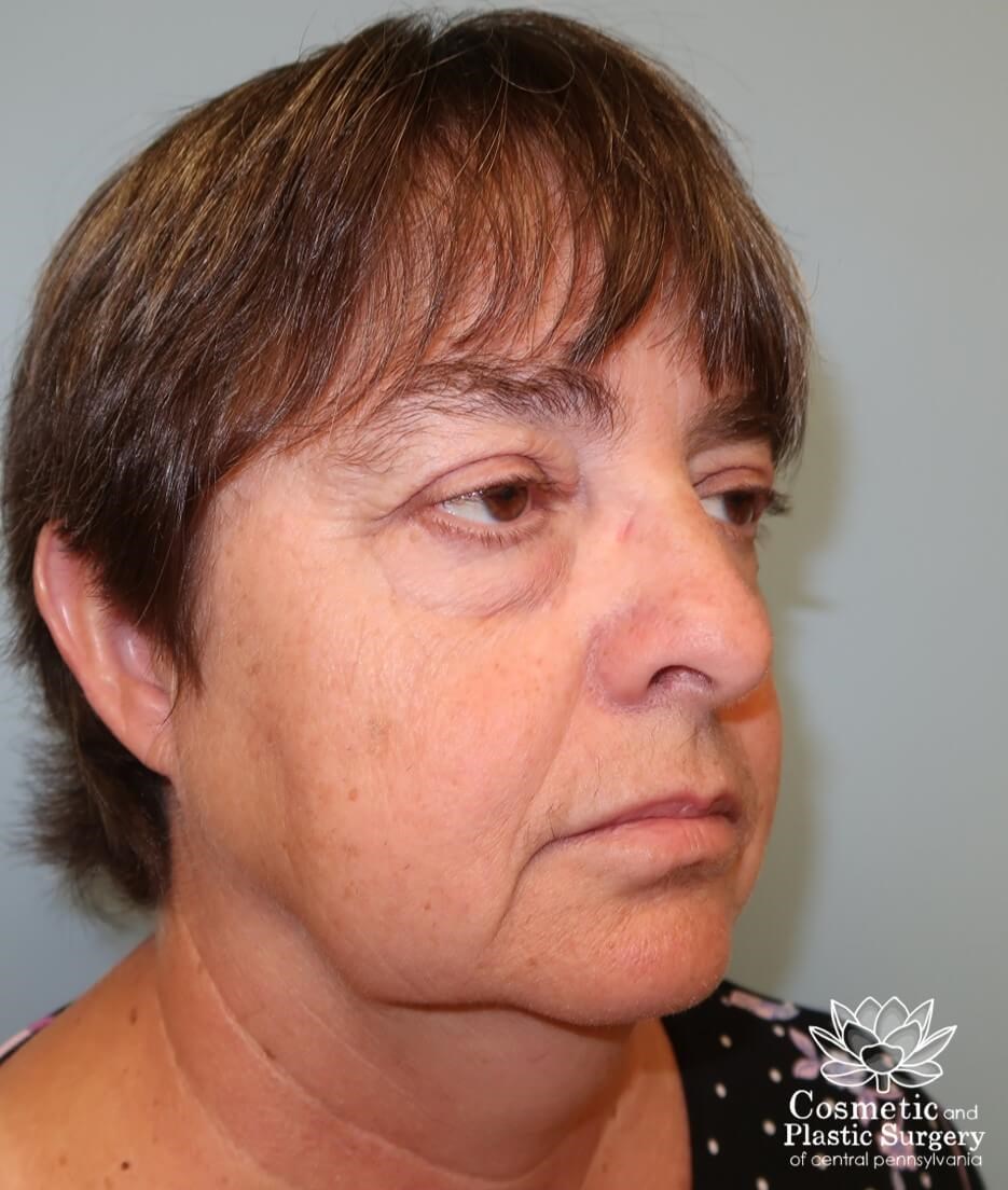 Blepharoplasty (upper eyelid) Before