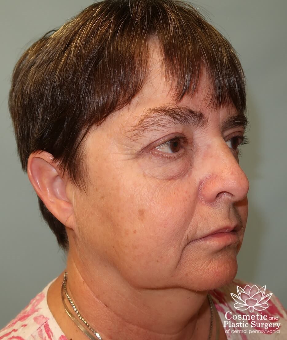 Blepharoplasty (upper eyelid) After