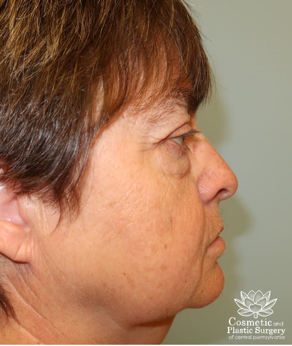 Blepharoplasty (upper eyelid) Before