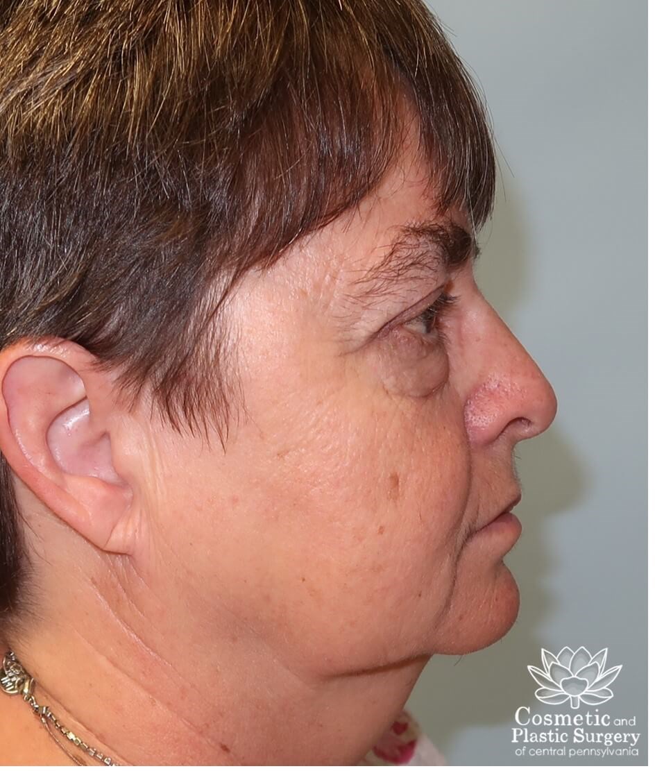 Blepharoplasty (upper eyelid) After