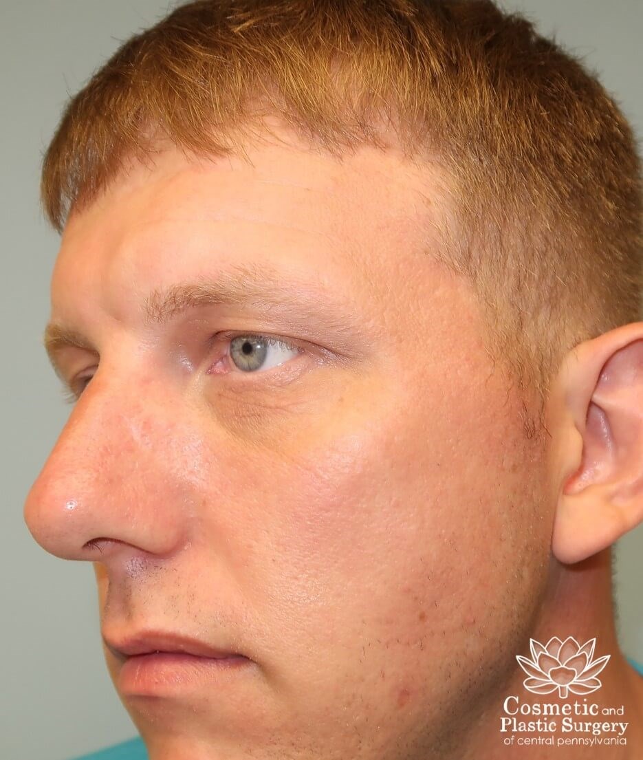 Lower Blepharoplasty Before