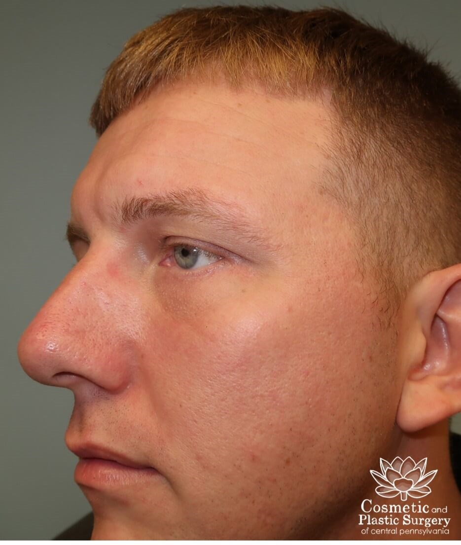 Lower Blepharoplasty After