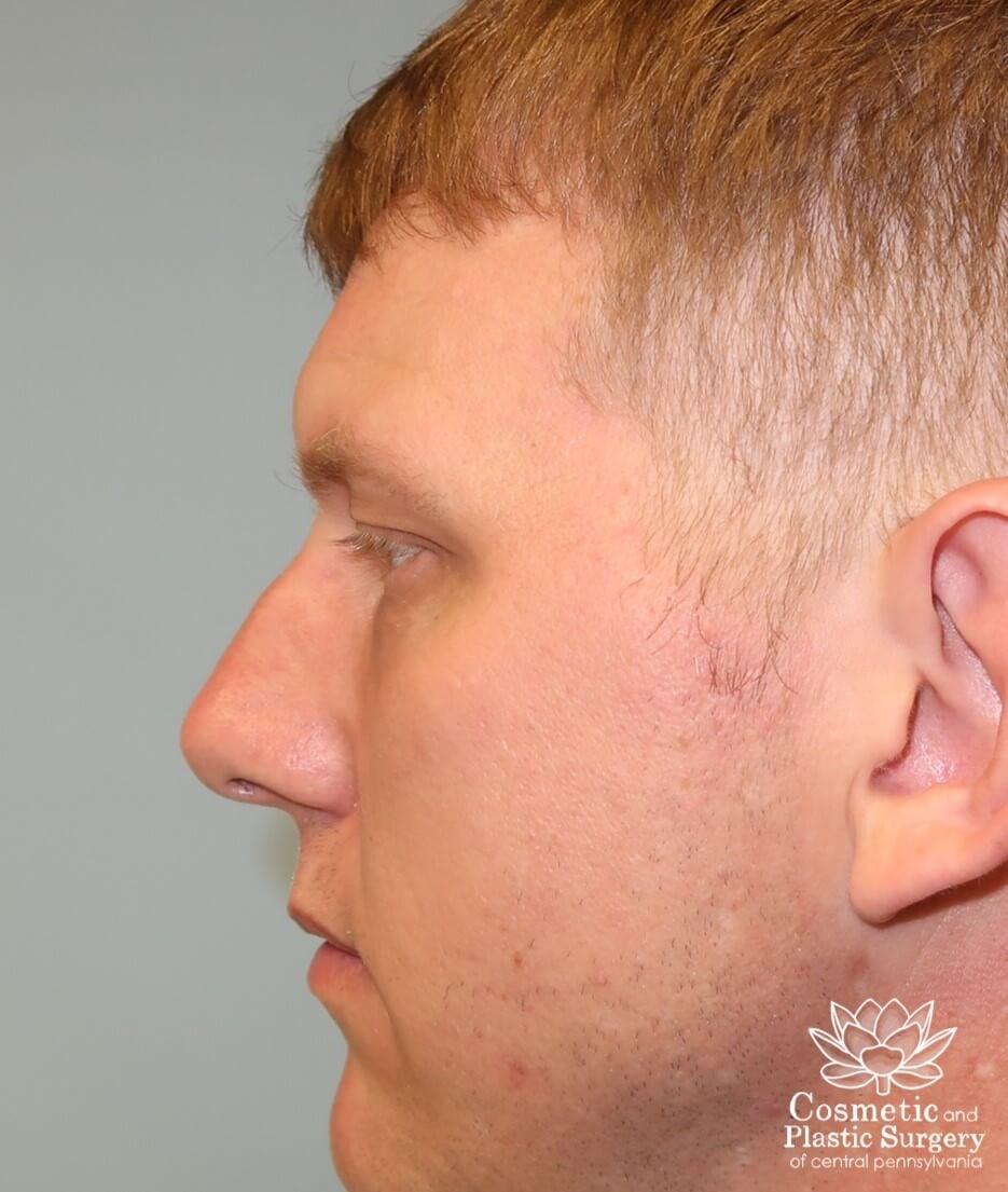 Lower Blepharoplasty Before