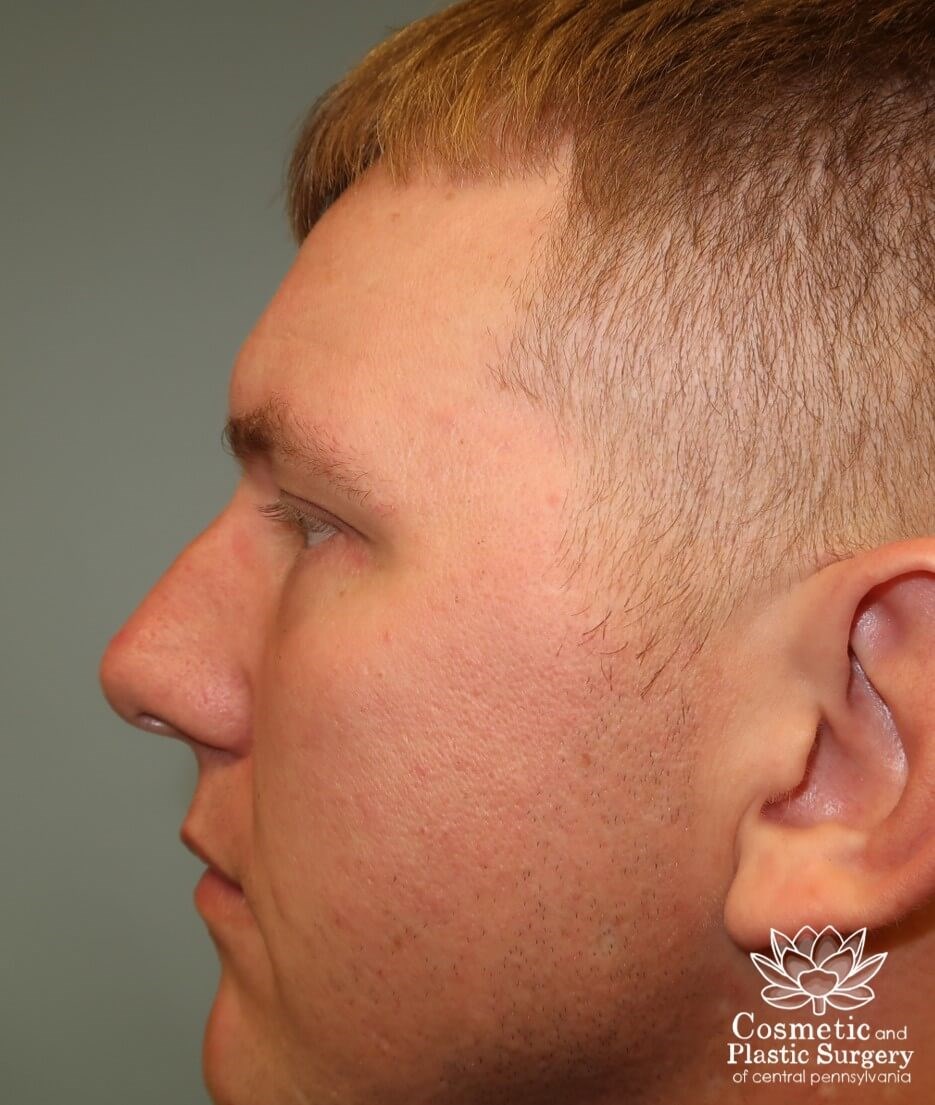 Lower Blepharoplasty After