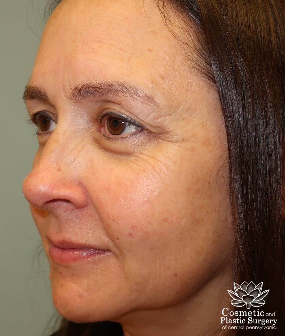 Upper Eyelid Blepharoplasty Before