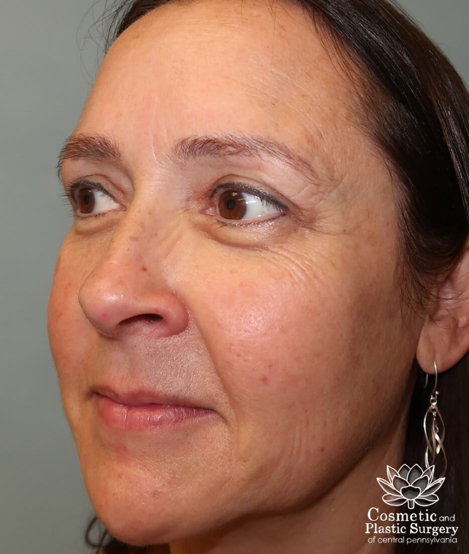Upper Eyelid Blepharoplasty After